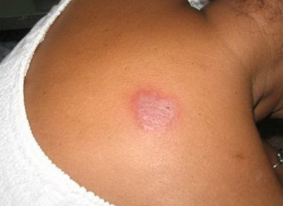 Lepra: la detección temprana previene discapacidades