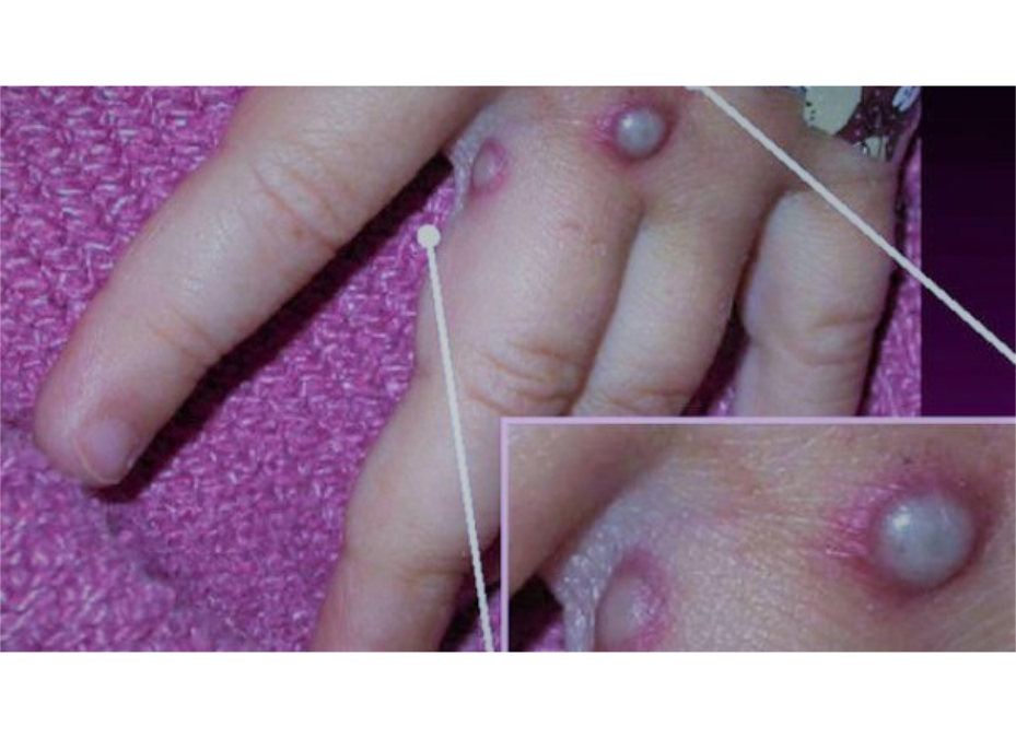Viruela del simio: fiebre y sarpullido síntomas que dieron con el diagnóstico