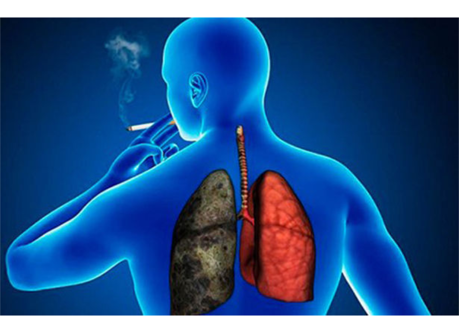 Tabaquismo: principal causante de las enfermedades pulmonares