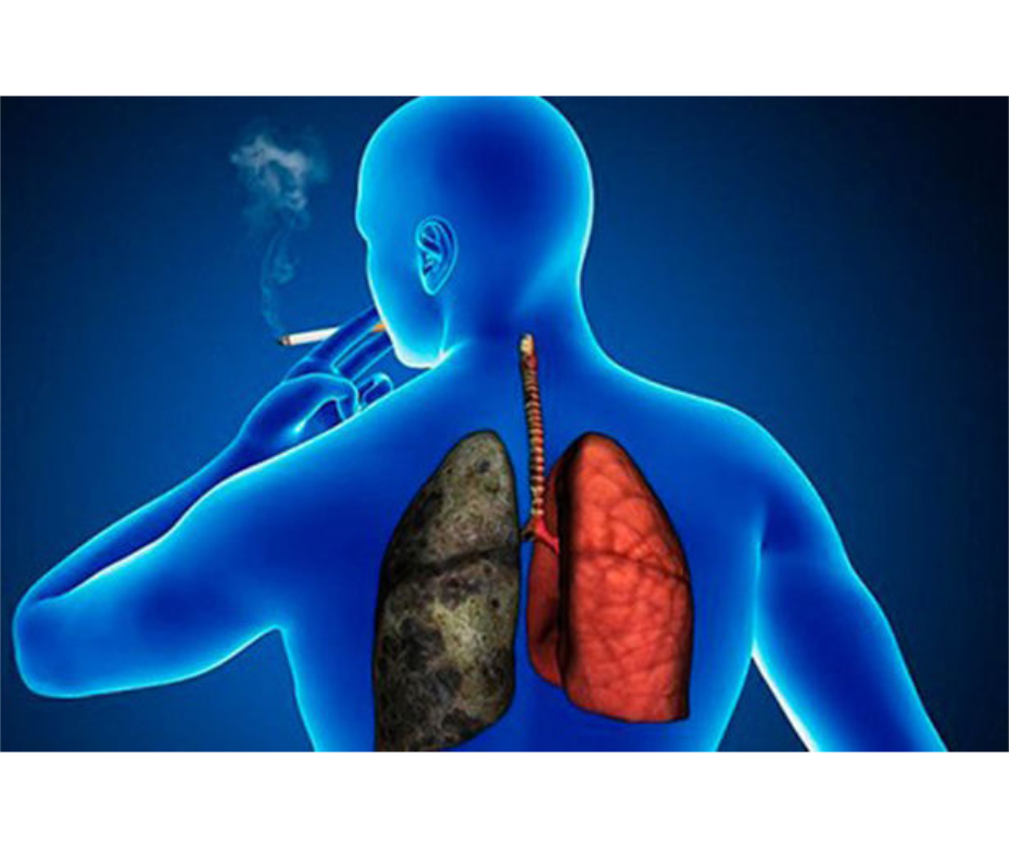 Tabaquismo principal causante de las enfermedades pulmonares – 20-09-2021