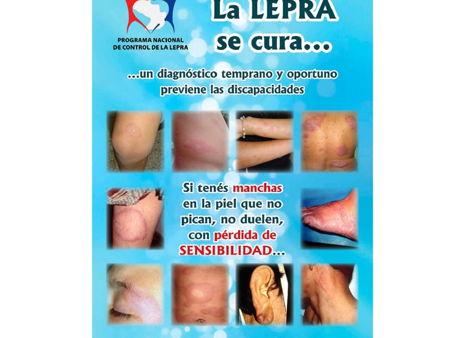 Lepra: unos 350 casos al año se diagnostican en el país