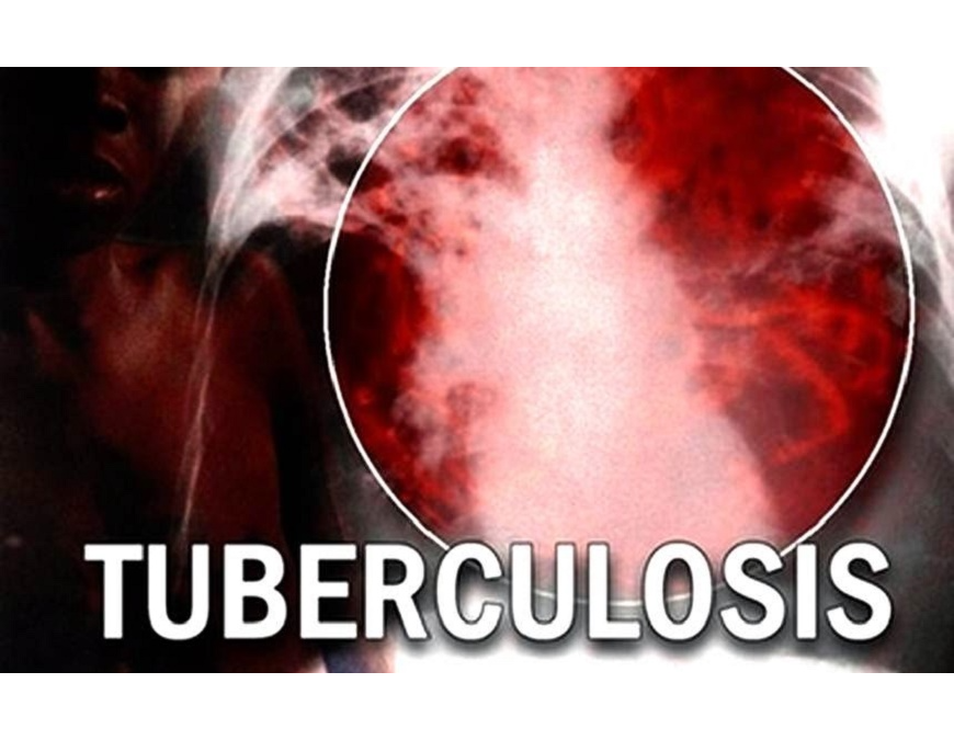Lo que debes saber acerca de la tuberculosis