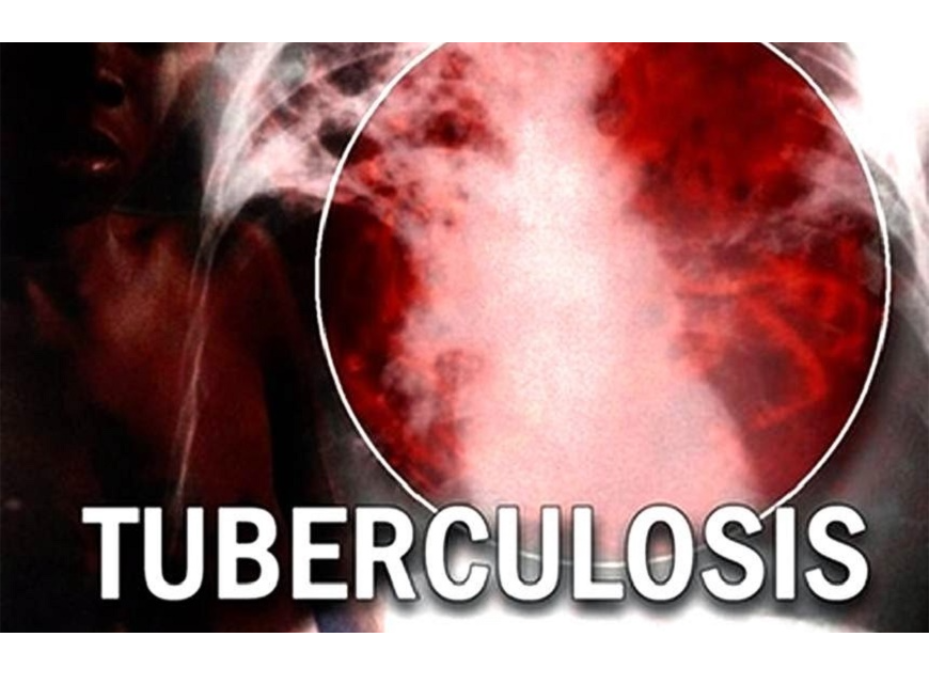 Tratarán sobre presupuesto regional a favor de la tuberculosis