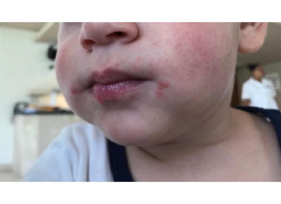 Alertan sobre enfermedad de manos, pies y boca, muy frecuente en niños pequeños
