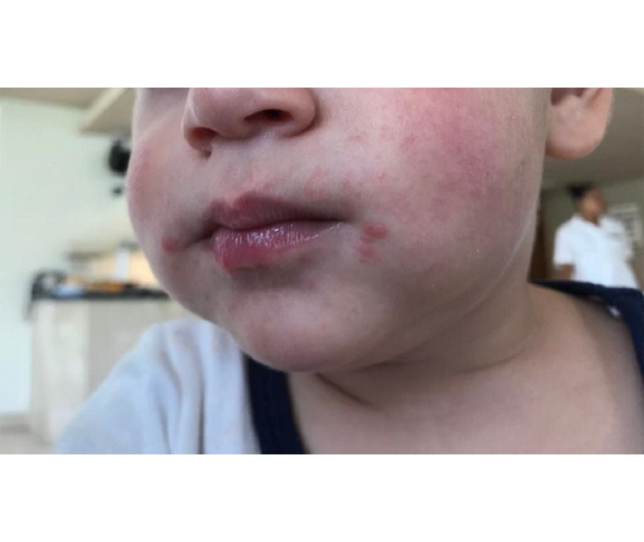 Alertan sobre enfermedad de manos, pies y boca, muy frecuente en niños pequeños – 01-04-2022