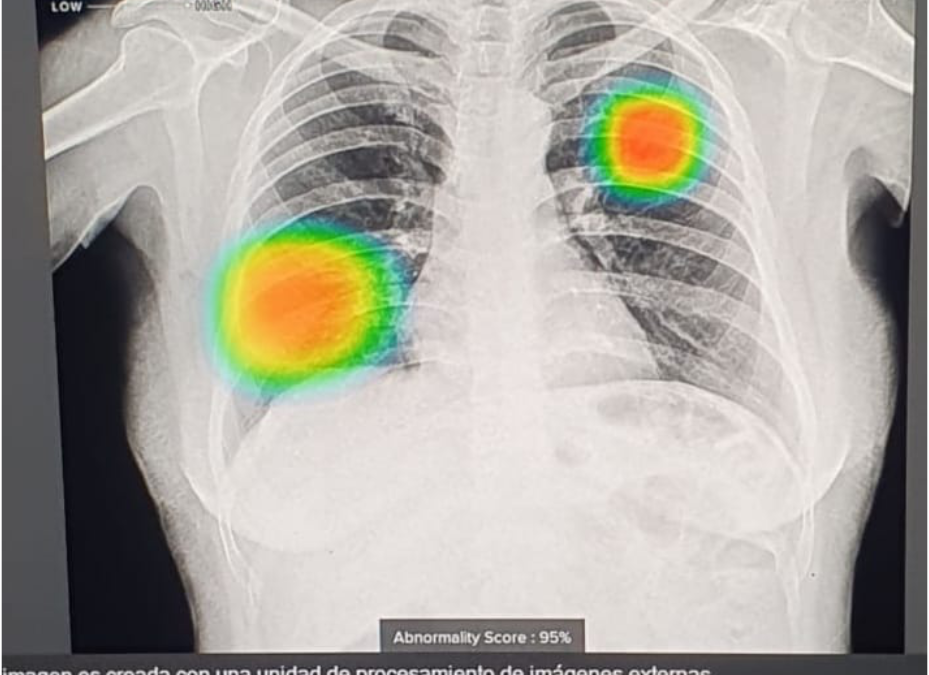 Salud recibe equipo de radiografía con inteligencia artificial para tuberculosis