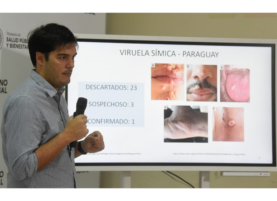 Viruela símica: Paraguay se mantiene con un caso confirmado