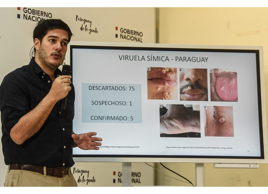 Viruela símica: Sequera ratifica circulación comunitaria en el país