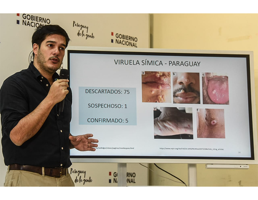 Viruela símica: Sequera ratifica circulación comunitaria en el país