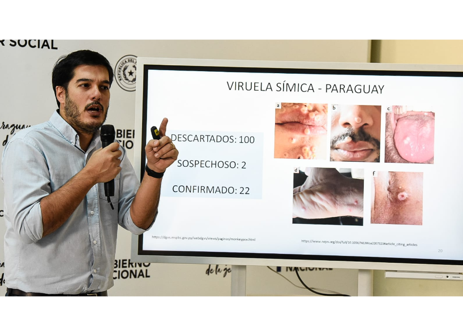 Viruela símica: incrementa a 22 los casos en el país