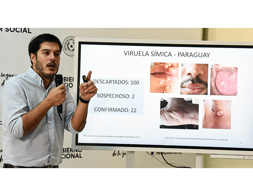 Viruela símica: incrementa a 22 los casos en el país