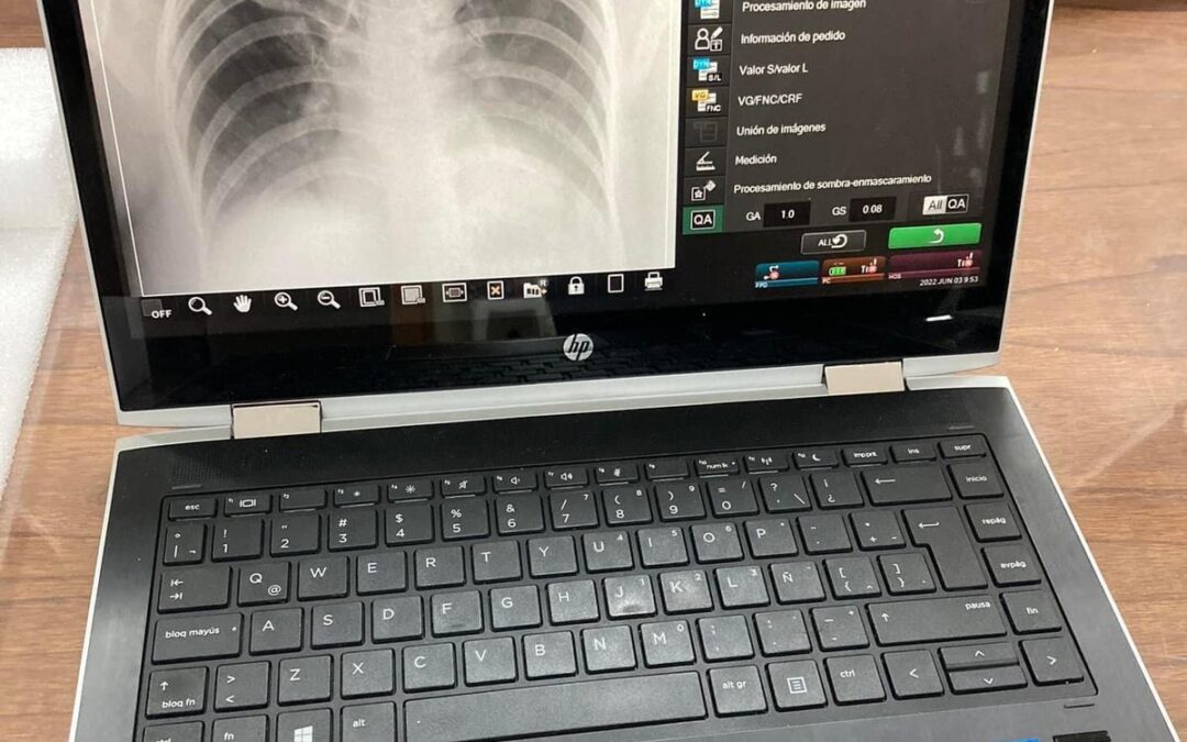 Salud recibe equipo de radiografía con inteligencia artificial para tuberculosis