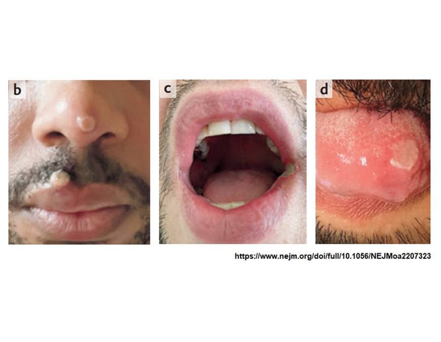 Incrementan contagios de viruela símica