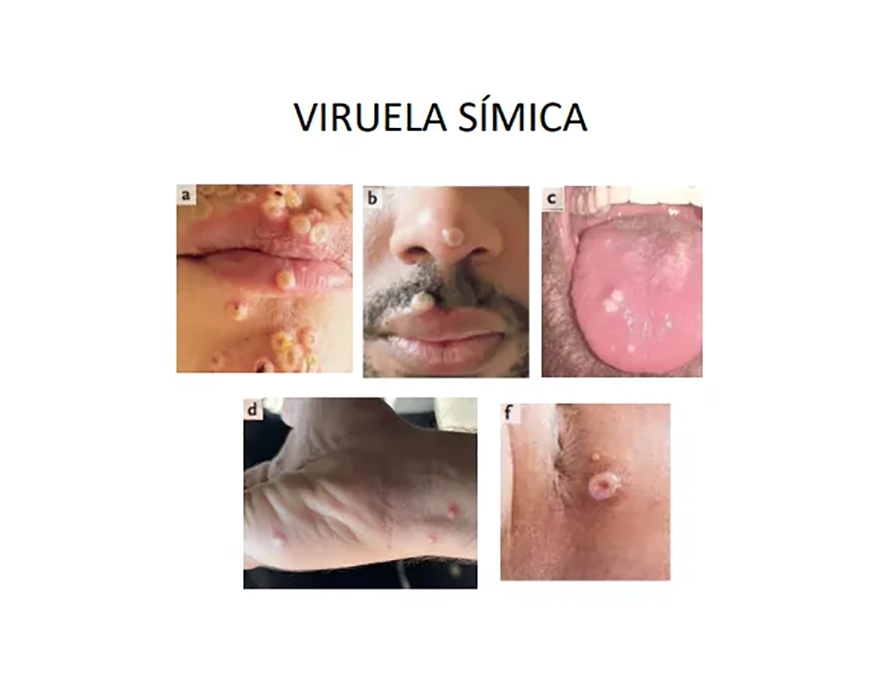 Viruela símica: el riesgo sigue latente