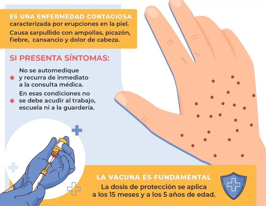 Medidas de prevención ante casos de varicela