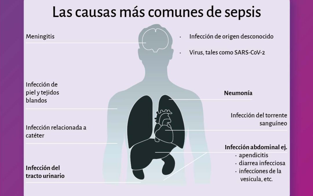 Sepsis: enfermedad peligrosa y frecuente que afecta a miles en el mundo