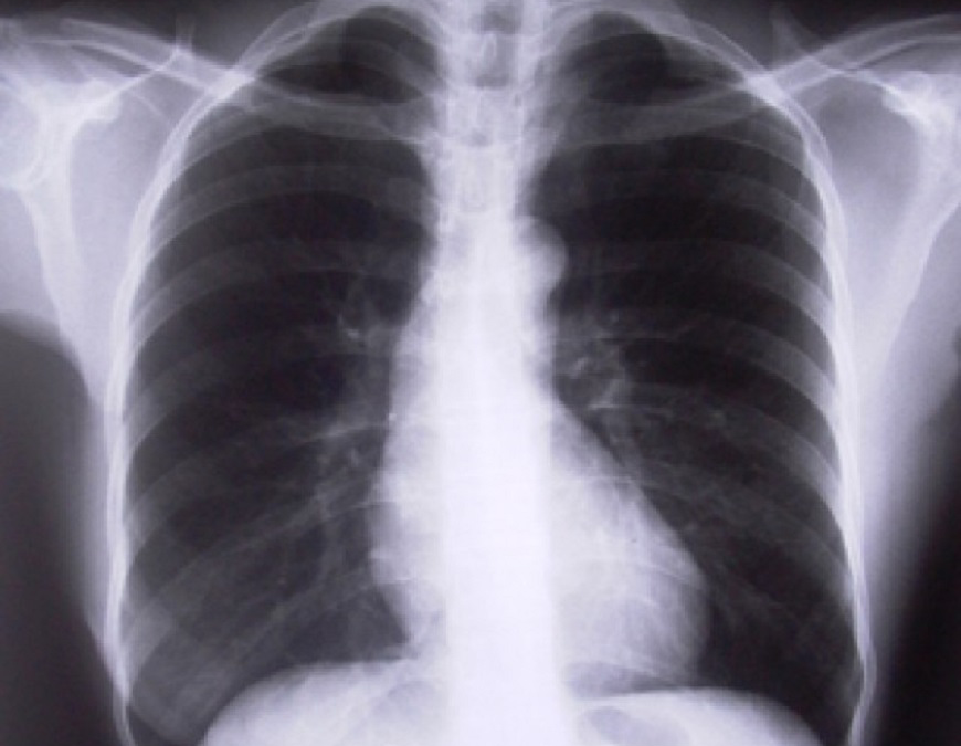 EPOC: diagnóstico y tratamiento tempranos frenan el empeoramiento de síntomas