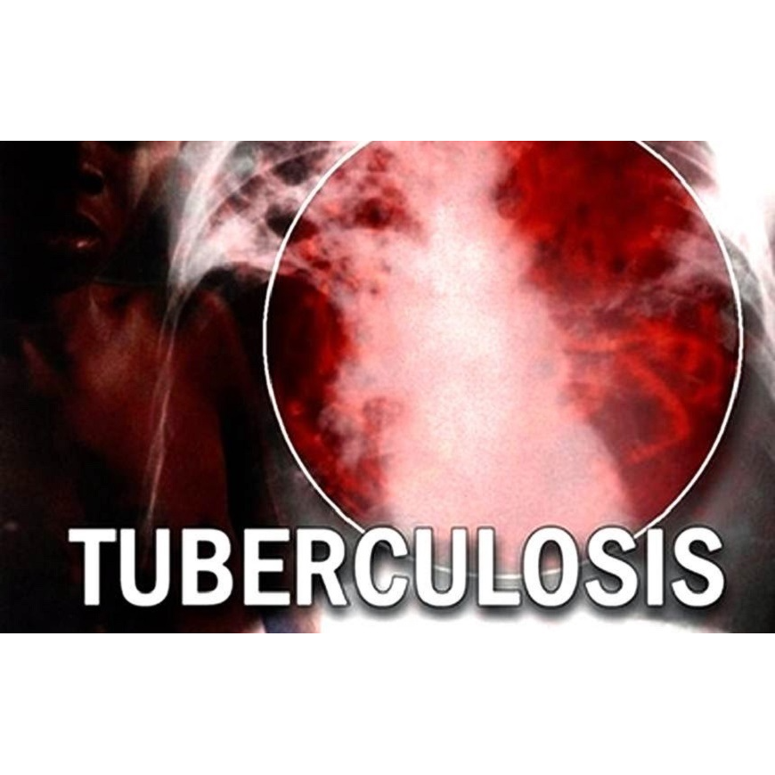 Fin a la tuberculosis delinearán estrategias de trabajo para el próximo año – 13-12-2021