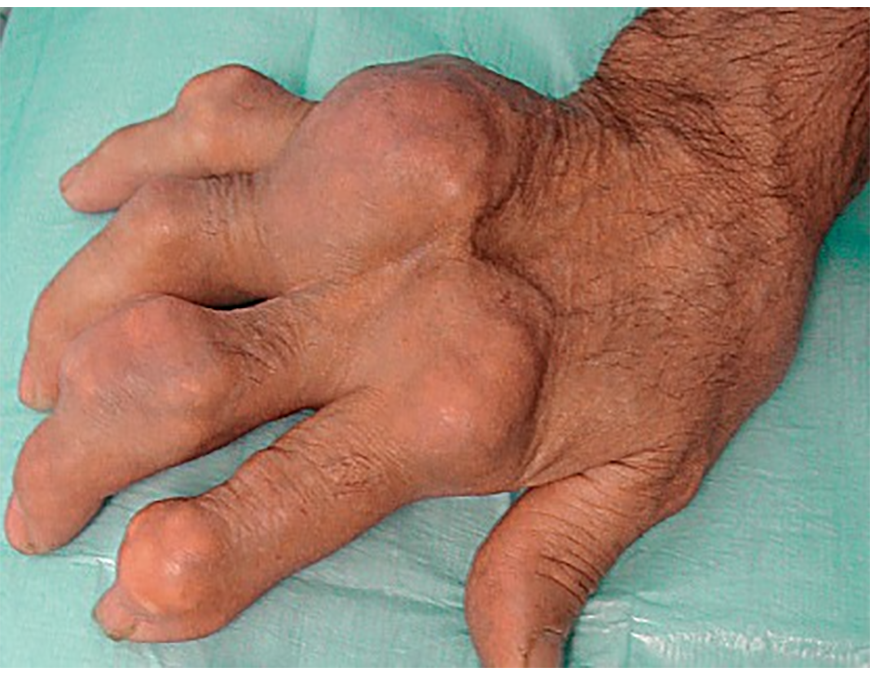 Gota, enfermedad asociada a niveles elevados de ácido úrico