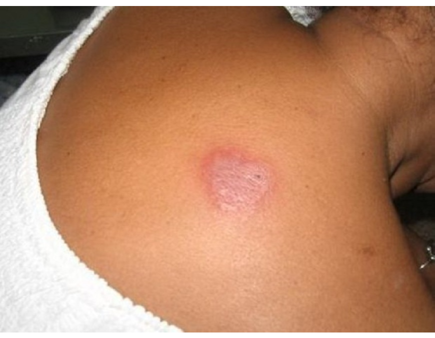 Lepra: la detección temprana previene discapacidades