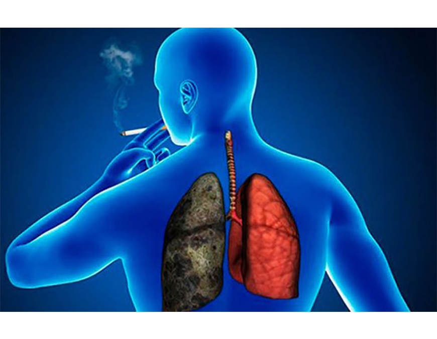Tabaquismo: principal causante de las enfermedades pulmonares