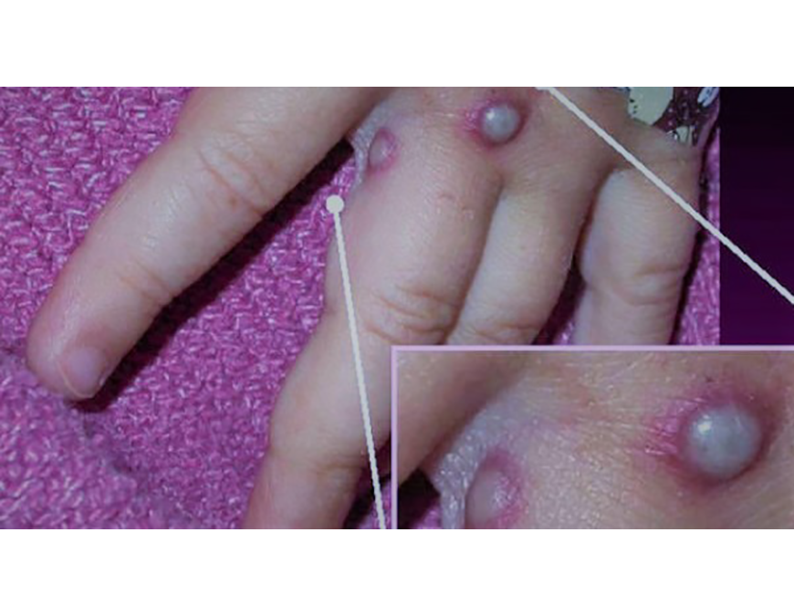 Viruela del simio: fiebre y sarpullido síntomas que dieron con el diagnóstico