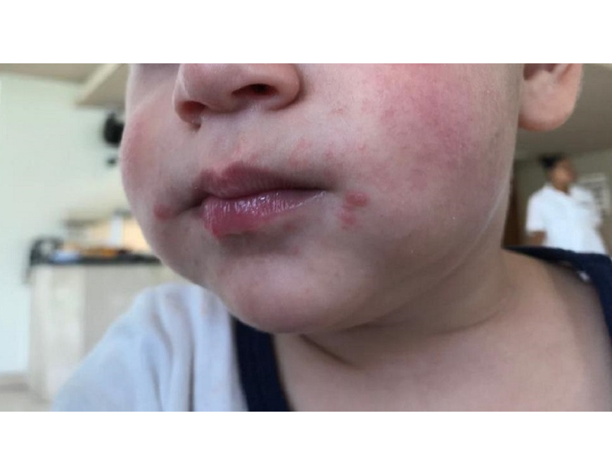 Alertan sobre enfermedad de manos, pies y boca, muy frecuente en niños pequeños