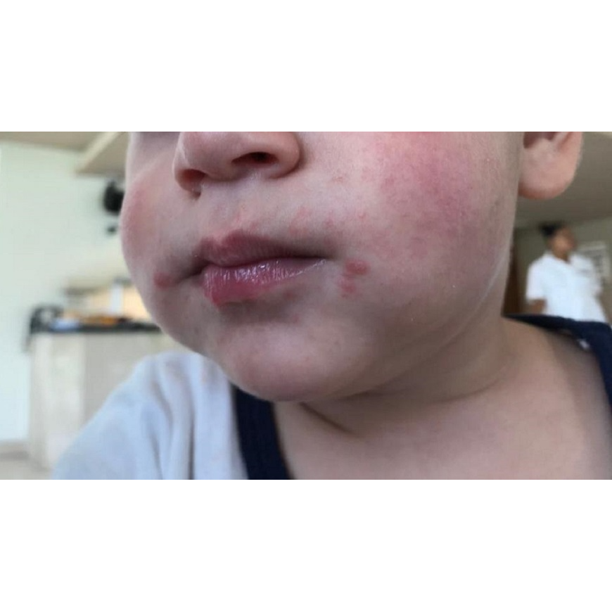 Alertan sobre enfermedad de manos, pies y boca, muy frecuente en niños pequeños – 01-04-2022