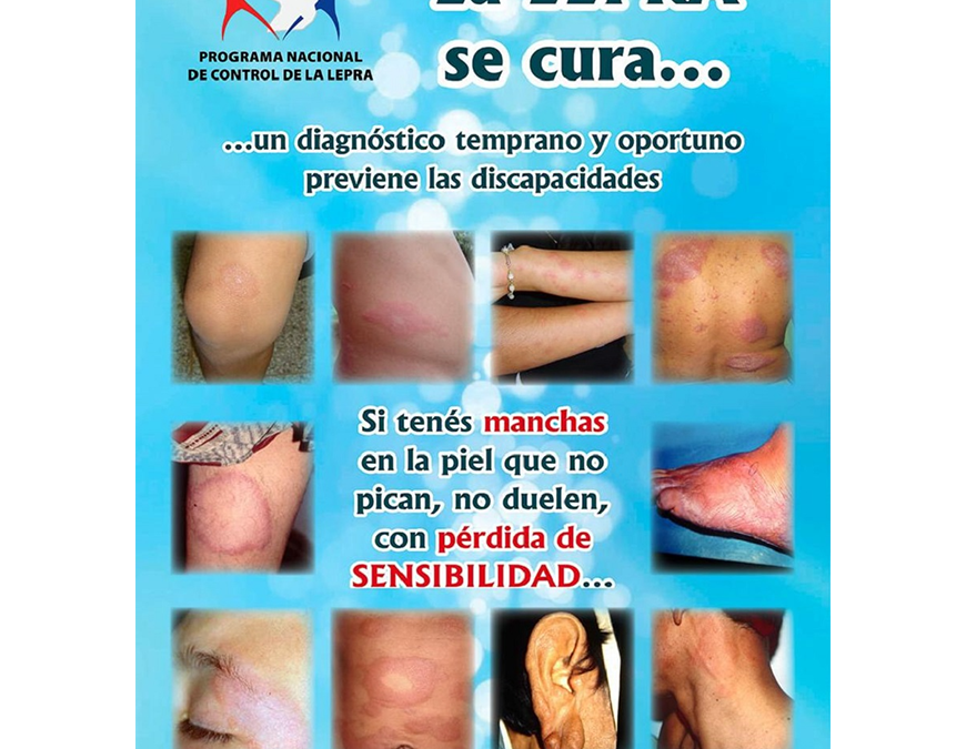 Lepra: unos 350 casos al año se diagnostican en el país