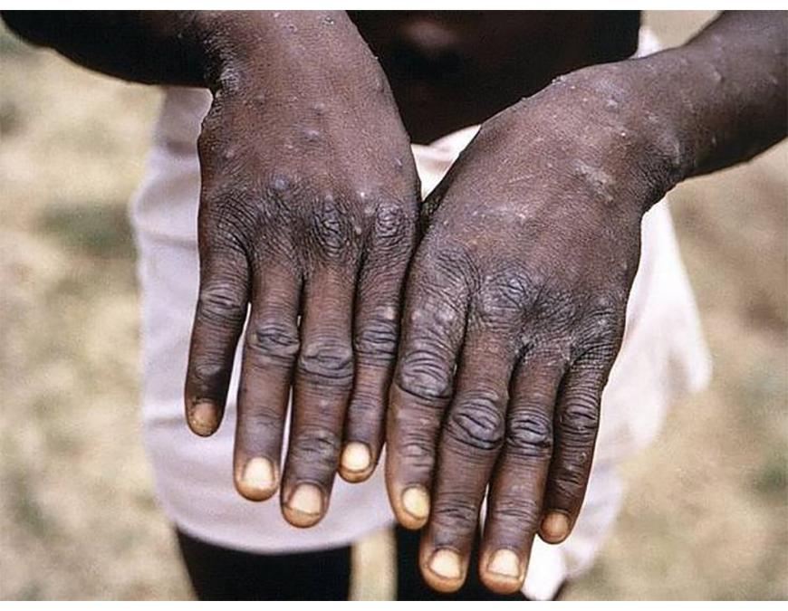 Viruela del mono, el virus en investigación