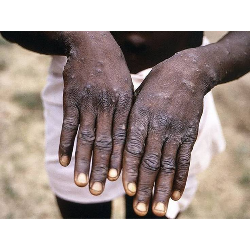 Viruela del mono, el virus en investigación – 20-05-2022