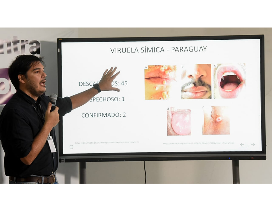 Viruela símica: Paraguay con 2 casos confirmados y uno en estudio