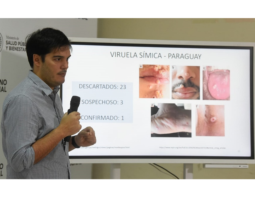 Viruela símica: Paraguay se mantiene con un caso confirmado