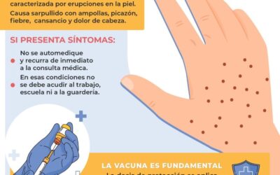 Ministerio de Salud confirma varicela en viajero proveniente de Bolivia